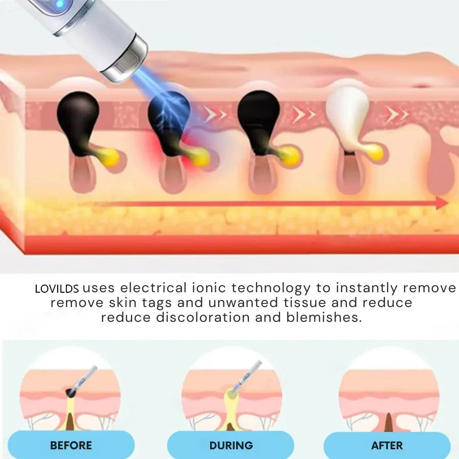 🔥【OFFICIAL STORE】TIWORLD™ Non-Invasive Mole and Wart Removal Laser Pen