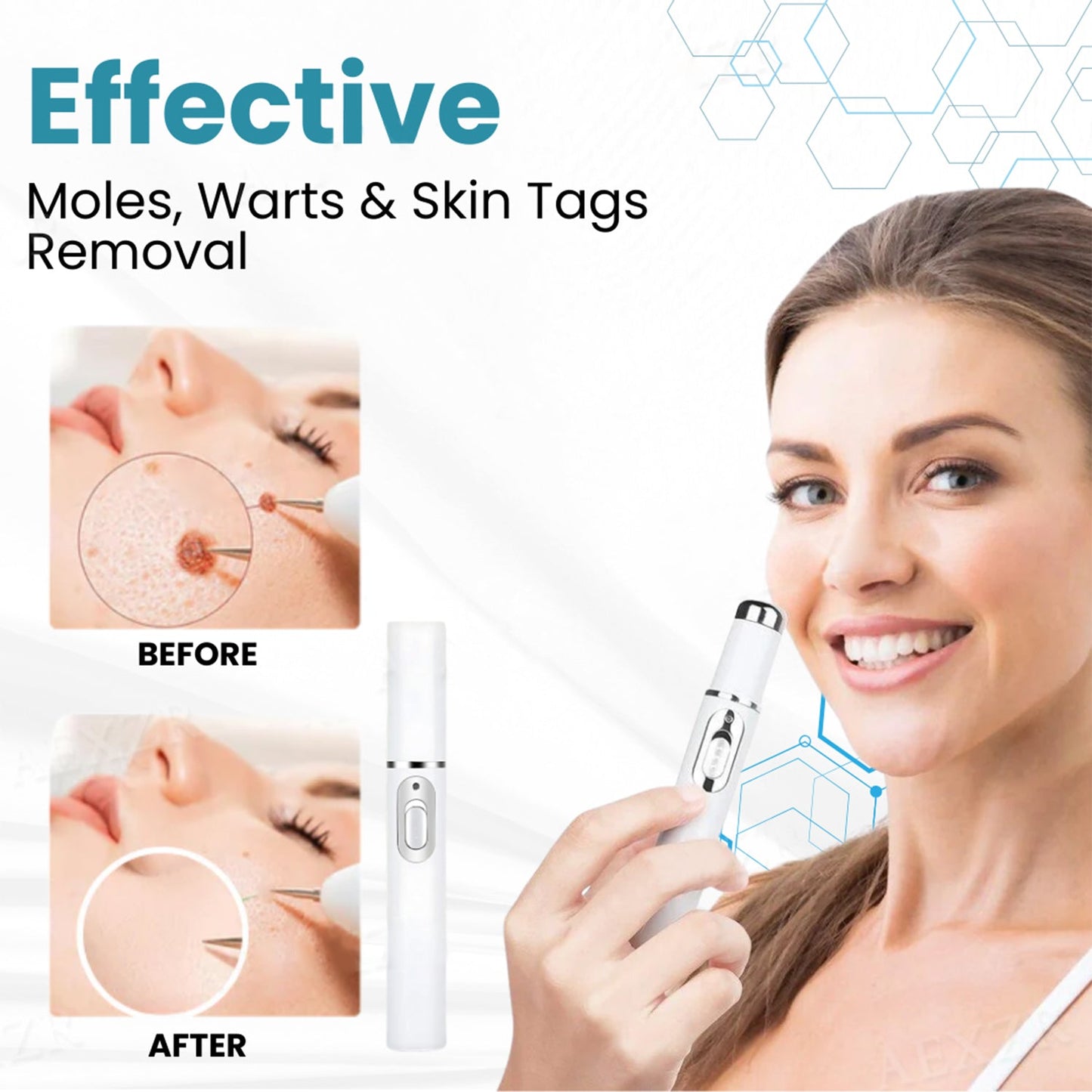 🔥【OFFICIAL STORE】TIWORLD™ Non-Invasive Mole and Wart Removal Laser Pen